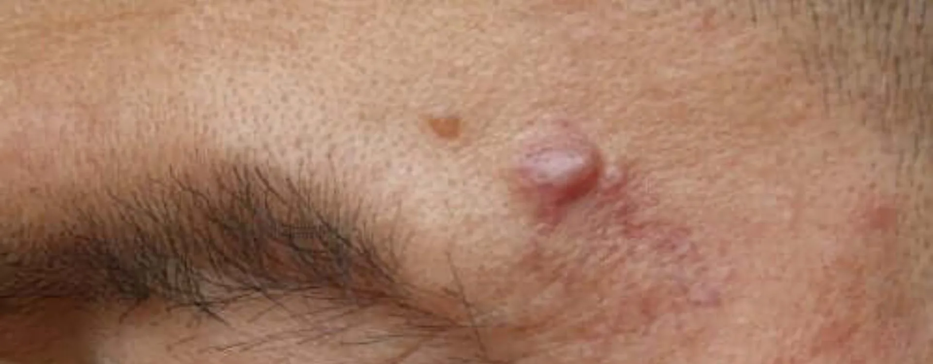 uma pele com cisto epidérmico