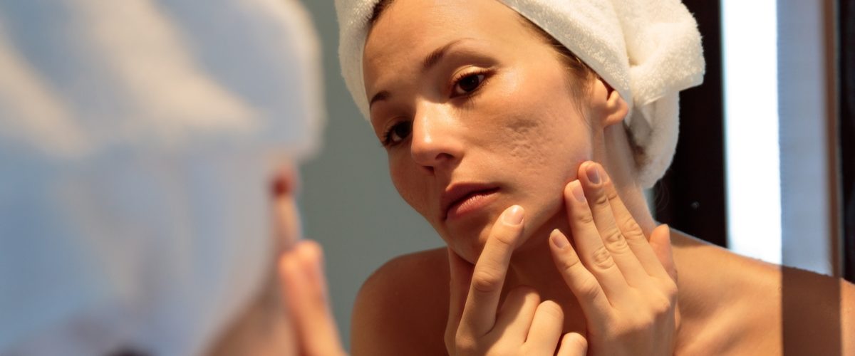 O que é a acne e como ela pode ser tratada?