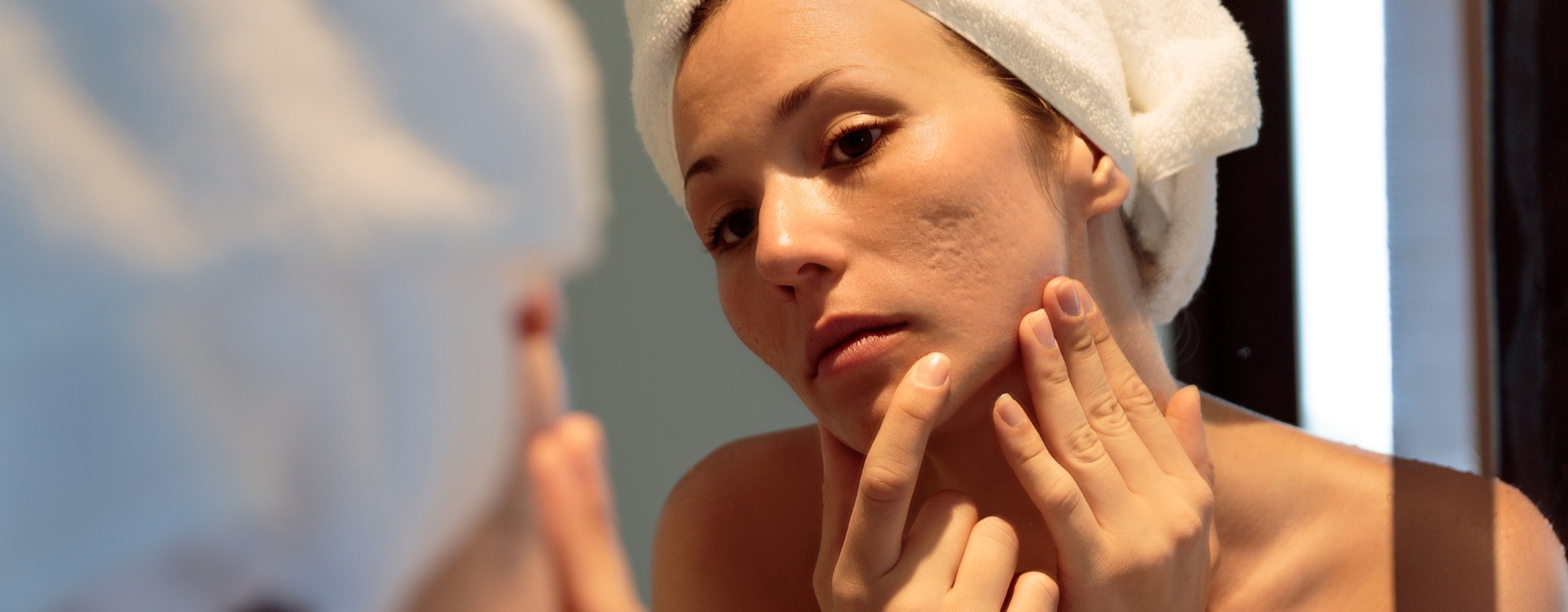 Você está visualizando atualmente O que é a acne e como ela pode ser tratada?