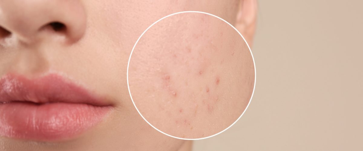 Quais tratamentos estéticos indicados para quem tem acne? 