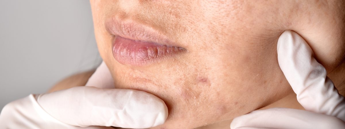 Como tratar cicatrizes de acne que persistem na vida adulta? 