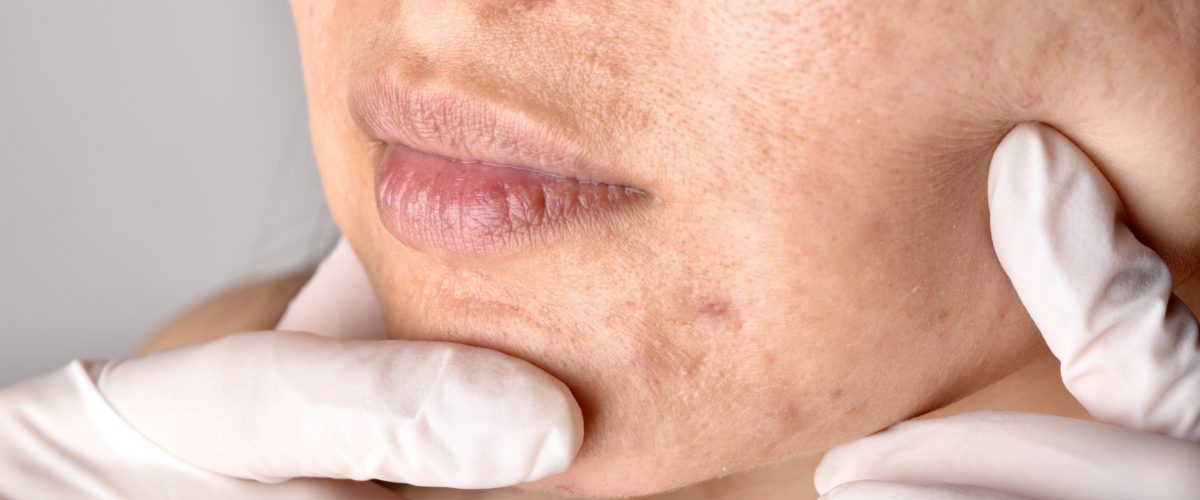 Como tratar cicatrizes de acne que persistem na vida adulta? 