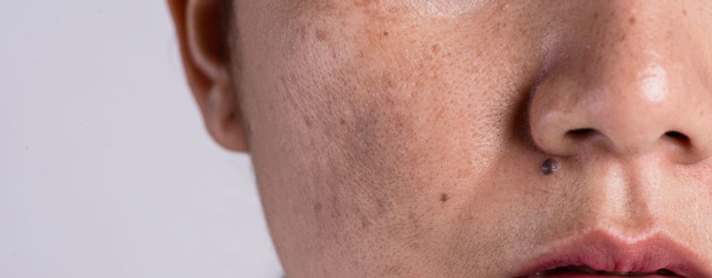 Pele oleosa: mitos e verdades sobre controle da oleosidade 