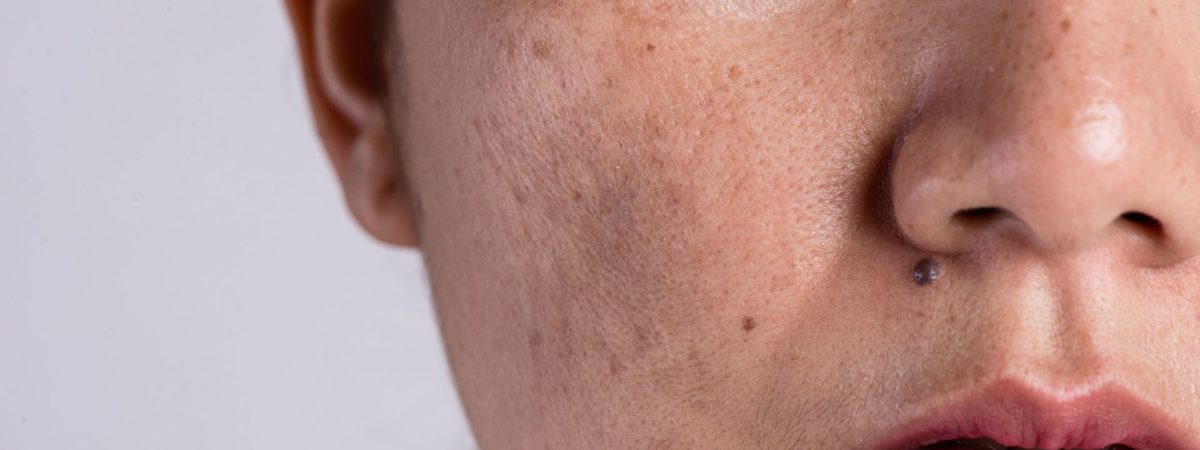 Pele oleosa: mitos e verdades sobre controle da oleosidade 