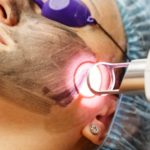 laser para manchas