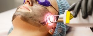 laser para manchas