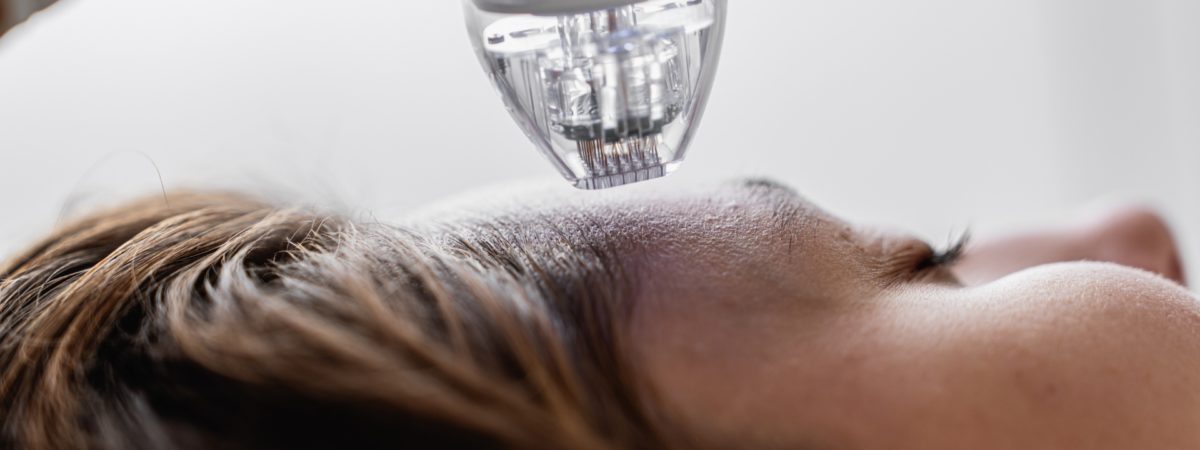 Microagulhamento: como esse tratamento pode ajudar na produção de colágeno 