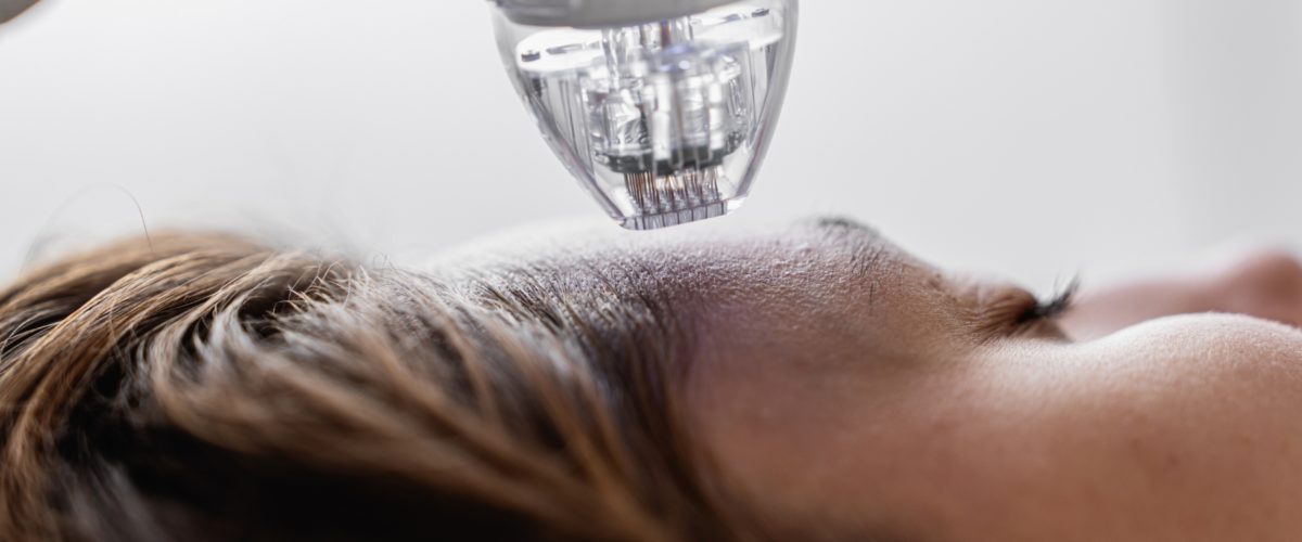 Microagulhamento: como esse tratamento pode ajudar na produção de colágeno 