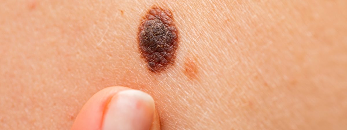 Melanoma: como identificar sinais suspeitos e quando procurar um dermatologista