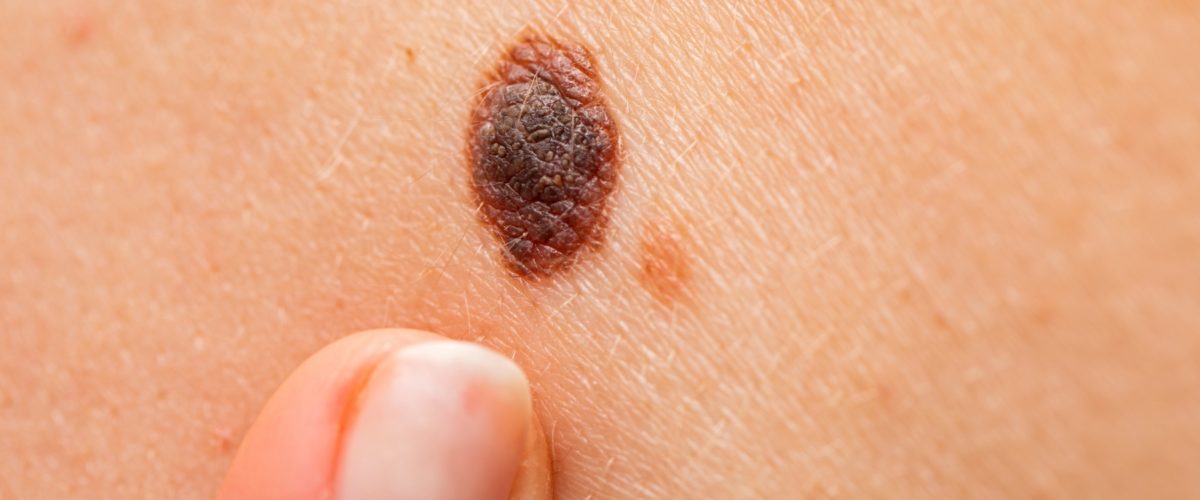 Melanoma: como identificar sinais suspeitos e quando procurar um dermatologista