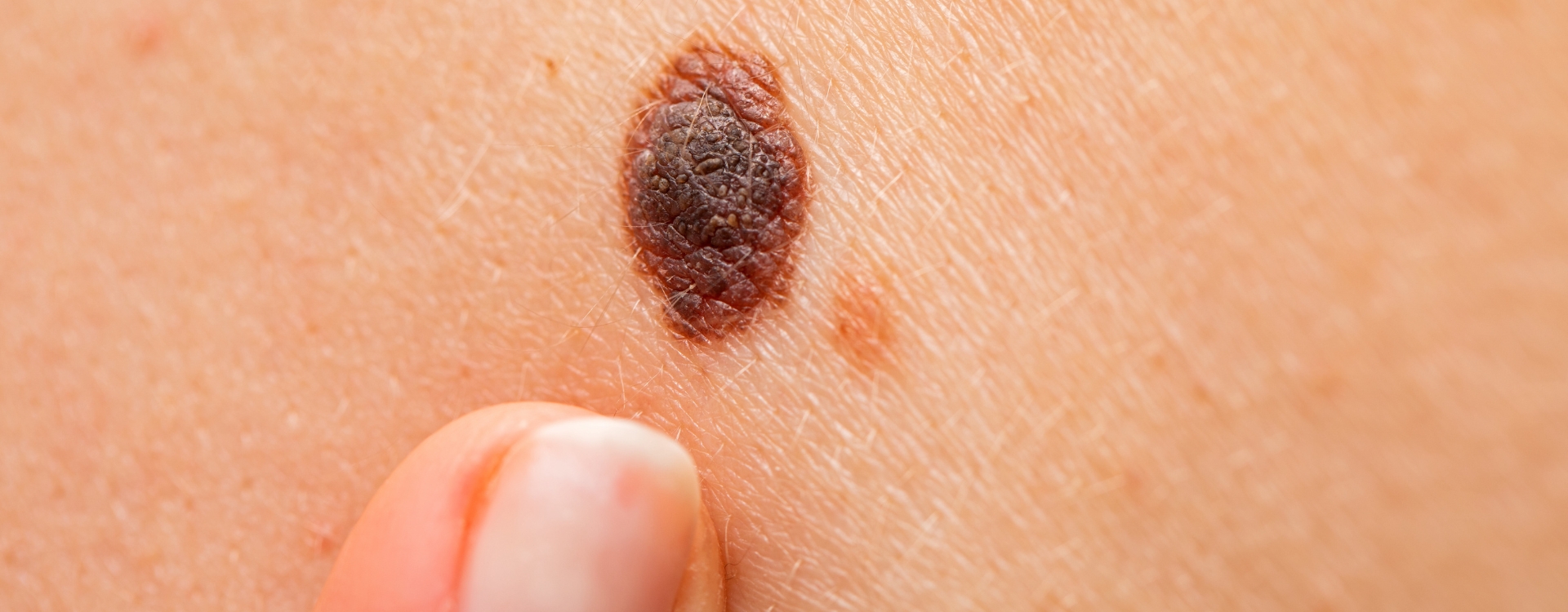 No momento, você está visualizando Melanoma: como identificar sinais suspeitos e quando procurar um dermatologista